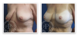 Breast Augmentation + Lift #006, before and after photo, view 2