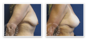Breast Augmentation + Lift #006, before and after photo, view 4