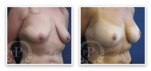 Breast Augmentation + Lift #006, before and after photo, view 5