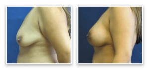 Breast Augmentation + Lift #004, before and after photo, view 2