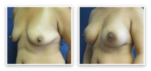 Breast Augmentation + Lift #004, before and after photo, view 3