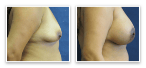 Breast Augmentation + Lift #004, before and after photo, view 4