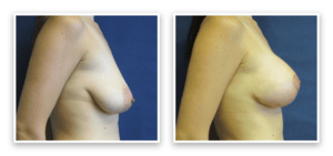 Breast Augmentation + Lift #001, before and after photo, view 3