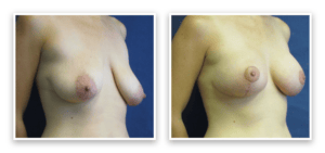 Breast Augmentation + Lift #001, before and after photo, view 2