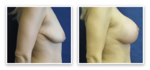 Breast Augmentation + Lift #003, before and after photo, view 3