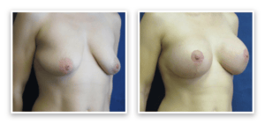 Breast Augmentation + Lift #003, before and after photo, view 2