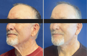 Face & Neck Lift #001, before and after photo, view 2