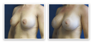 Implant Revision #001, before and after photo, view 4