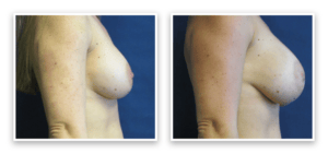 Implant Revision #001, before and after photo, view 3