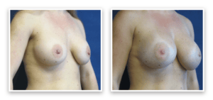 Implant Revision #001, before and after photo, view 2