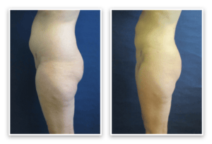 Liposuction #005, before and after photo, view 3