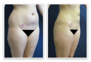 Liposuction #005, before and after photo, view 2