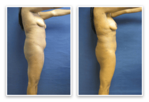 Liposuction  #007, before and after photo, view 2