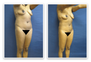 Liposuction  #007, before and after photo, view 3