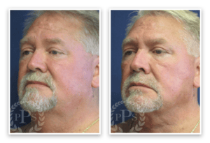 Liposuction #010, before and after photo, view 2