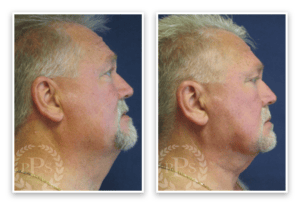 Liposuction #010, before and after photo, view 3