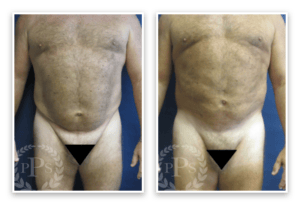 Liposuction #011, before and after photo, view 2