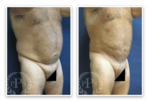 Liposuction #011, before and after photo, view 3