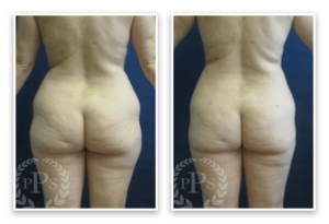 Liposuction #012, before and after photo, view 2