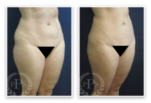 Liposuction #012, before and after photo, view 3