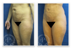 Liposuction #013, before and after photo, view 2