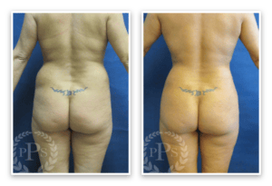 Liposuction #013, before and after photo, view 4