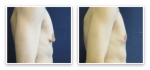 Male Breast Reduction #001, before and after photo, view 3