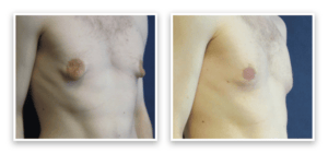 Male Breast Reduction #001, before and after photo, view 2