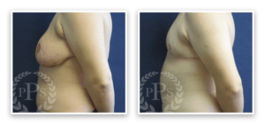 FTM Chest Masculinization Surgery #003, before and after photo, view 3