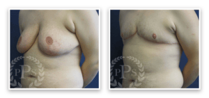 FTM Chest Masculinization Surgery #003, before and after photo, view 2