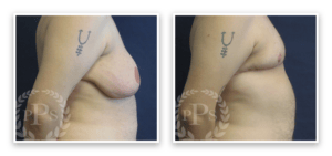 FTM Chest Masculinization Surgery #003, before and after photo, view 4