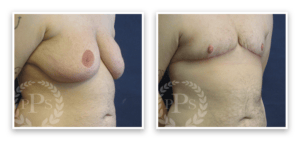 FTM Chest Masculinization Surgery #003, before and after photo, view 5