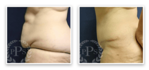 Tummy Tuck #010, before and after photo, view 2