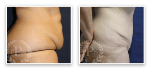 Tummy Tuck #010, before and after photo, view 3