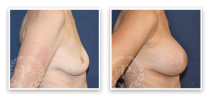 Breast Implant Revision #002, before and after photo, view 3