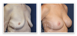 Breast Implant Revision #002, before and after photo, view 2