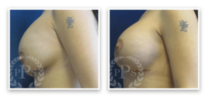 Breast Lift #006, before and after photo, view 3
