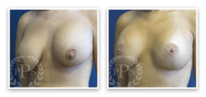 Breast Lift #006, before and after photo, view 2