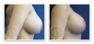 Breast Lift #006, before and after photo, view 5