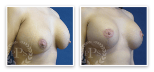 Breast Lift #006, before and after photo, view 4