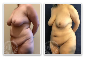 S.A.F.E. Liposculpture #001, before and after photo, view 2
