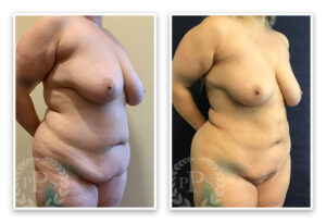 S.A.F.E. Liposculpture #001, before and after photo, view 3