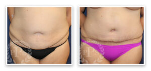 Mommy Makeover #001, before and after photo, view 7