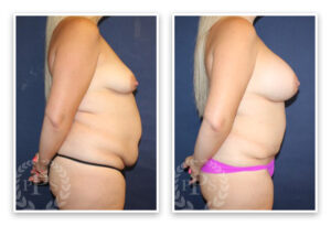 Mommy Makeover #001, before and after photo, view 3