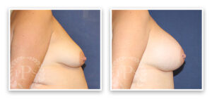 Mommy Makeover #001, before and after photo, view 6
