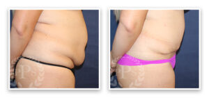 Mommy Makeover #001, before and after photo, view 9