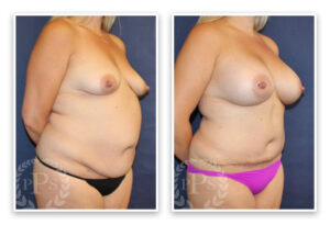 Mommy Makeover #001, before and after photo, view 2