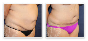 Mommy Makeover #001, before and after photo, view 8