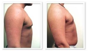 Male Breast Reduction #003, before and after photo, view 2