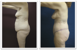 Body Lift #001, before and after photo, view 2
